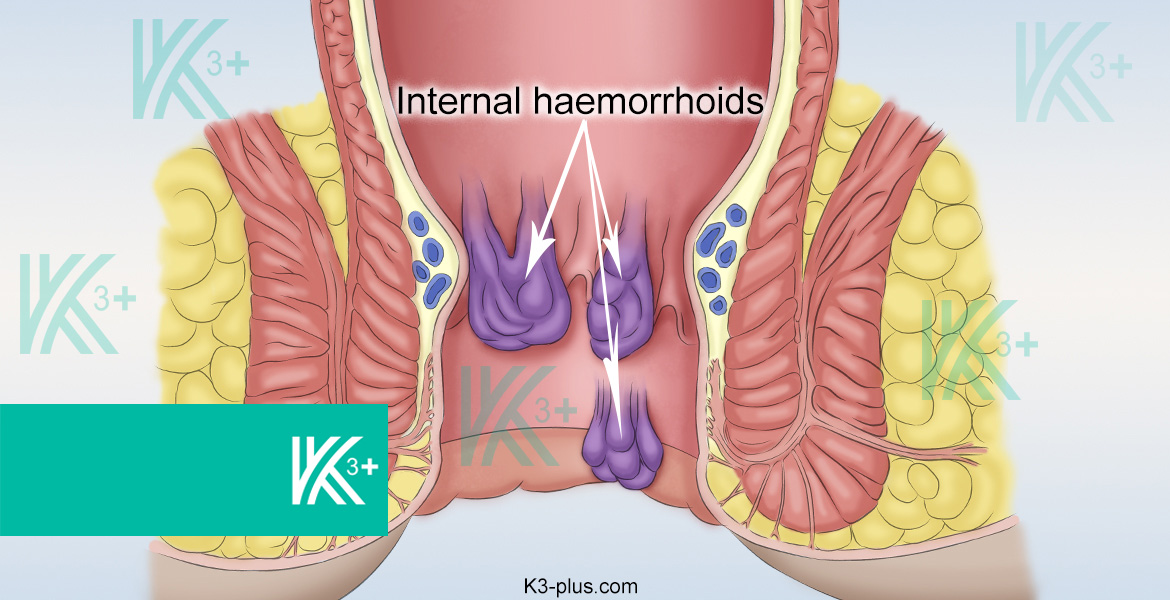 Internal Hemorrhoids Treatment in Dubai