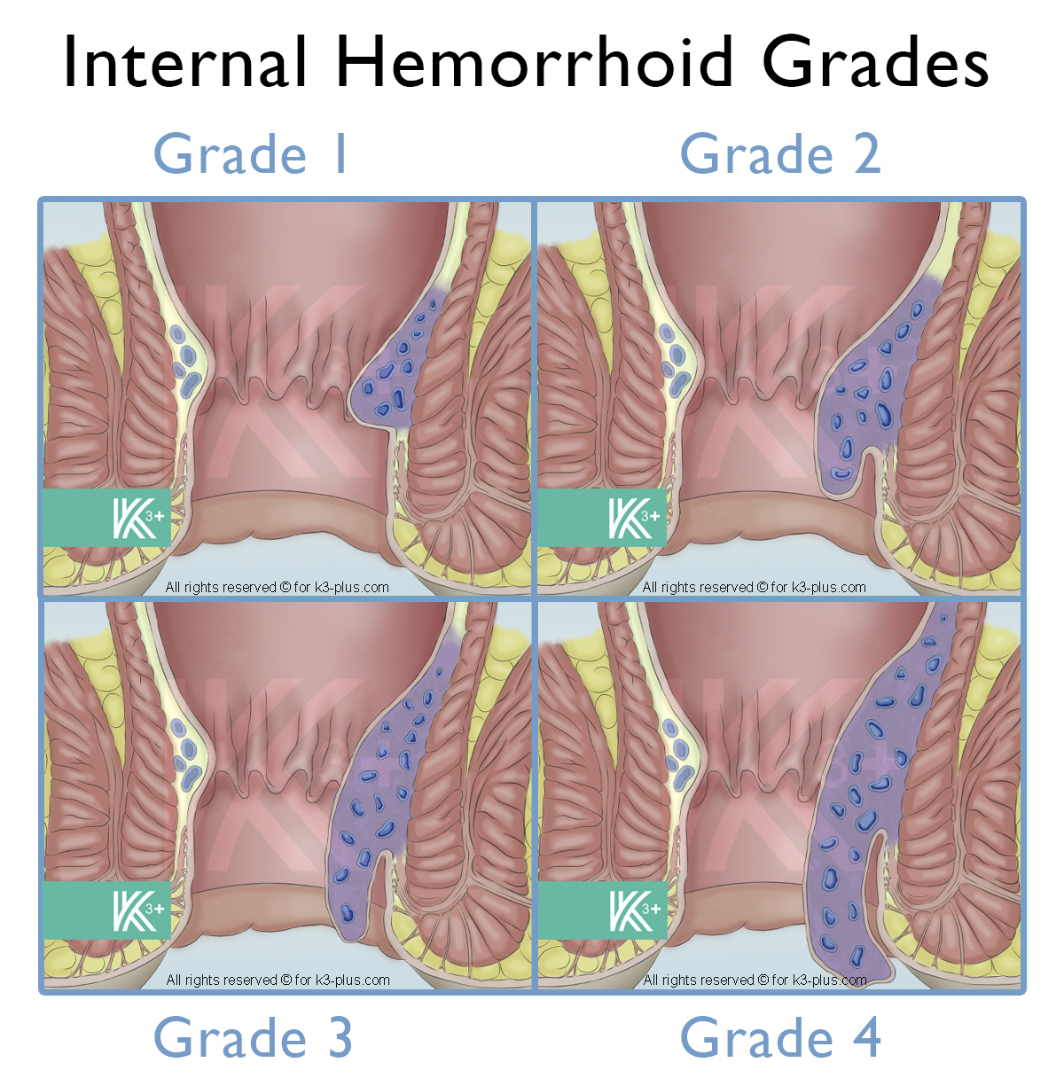 Internal Hemorrhoids grades