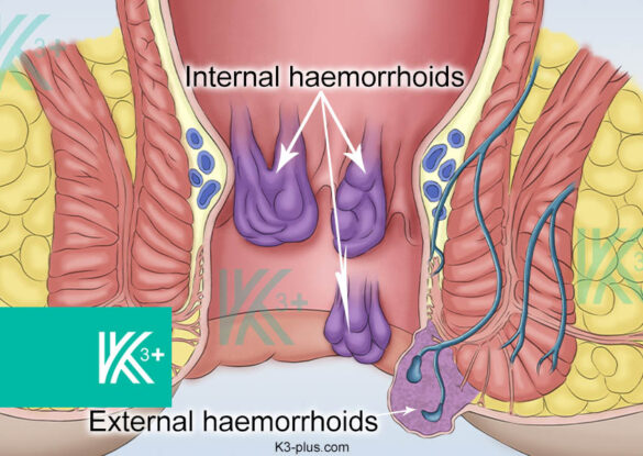 Hemorrhoids Treatment in Dubai without Surgery by Laser & Doppler