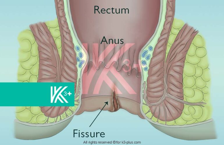 Fissure (Anal-Fissure) Causes, Symptoms, Treatment, Surgery & advices
